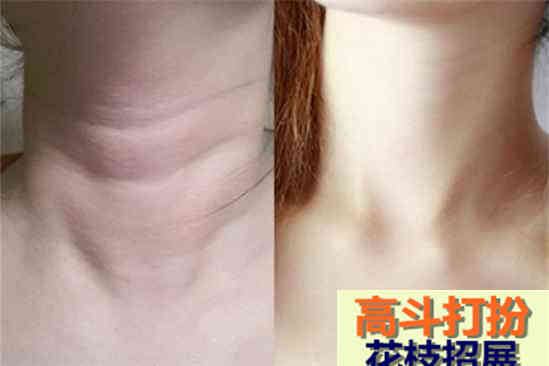 颈纹是怎么引起的颈纹怎么消除简单的方法_化妆护肤_高斗打扮